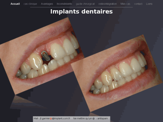 Photo image Les implants dentaires